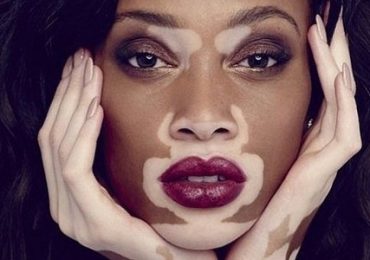 Vitiligo: sinais, prevenção e tratamento