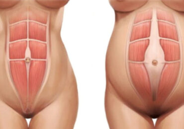 Afinal o que é a diástase abdominal?