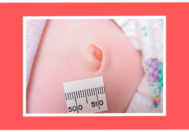 Granuloma Umbilical: o que é e como tratar